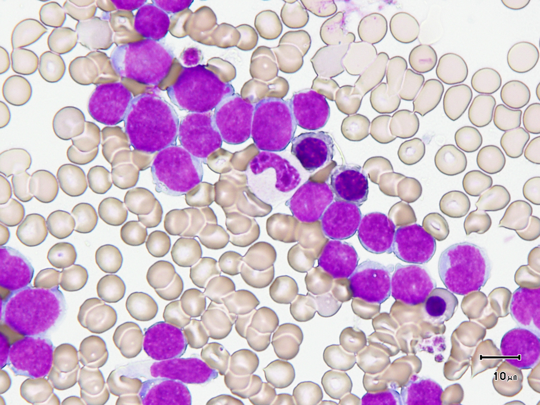 Acute leukemia cells