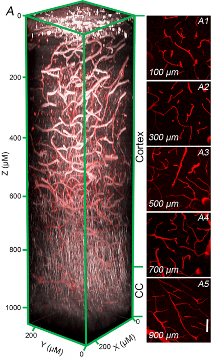 ApoE4 is implicated in Alzheimer's, vascular dementia